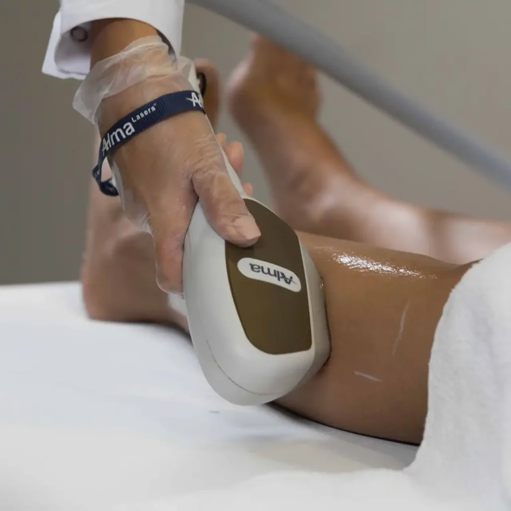 Epilation laser